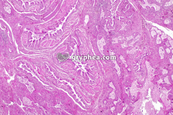 Poumon de fumeur x5 - gryphea.org